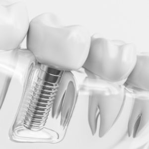 What Are Dental Implants