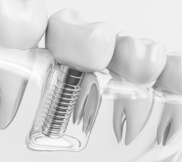 Dental implants